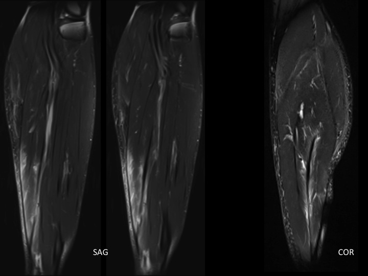 Figure 3 for case soleus muscle ( RID2924 )